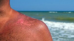 Sun Safety: Sun protection and Sunscreens