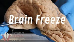 What Is a Brain Freeze?