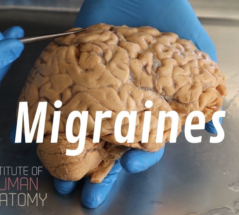 What Are Migraines?