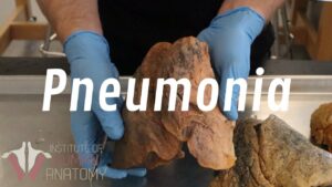 What Is Pneumonia?
