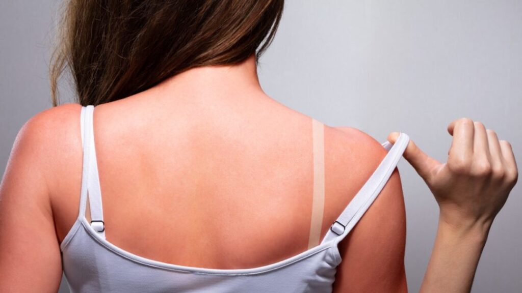 How do I treat a sunburn?