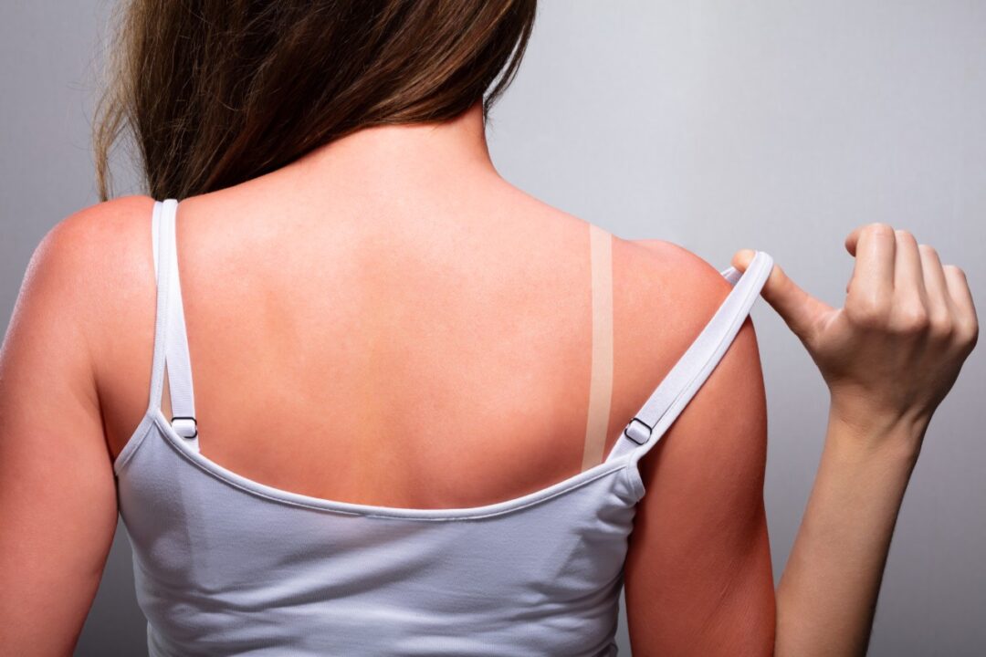 How do I treat a sunburn?, Health Channel