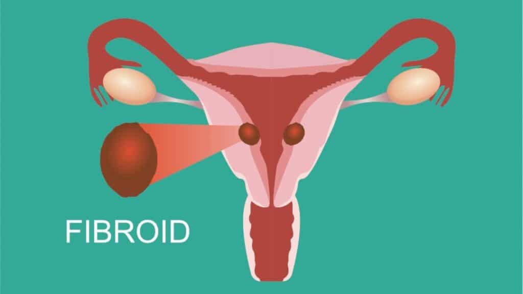 What are treatment options for uterine fibroids?