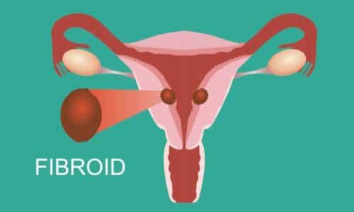 What are treatment options for uterine fibroids?