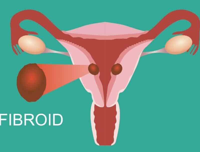 What are treatment options for uterine fibroids?