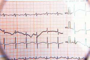 What does or doesn't an electrocardiogram say?