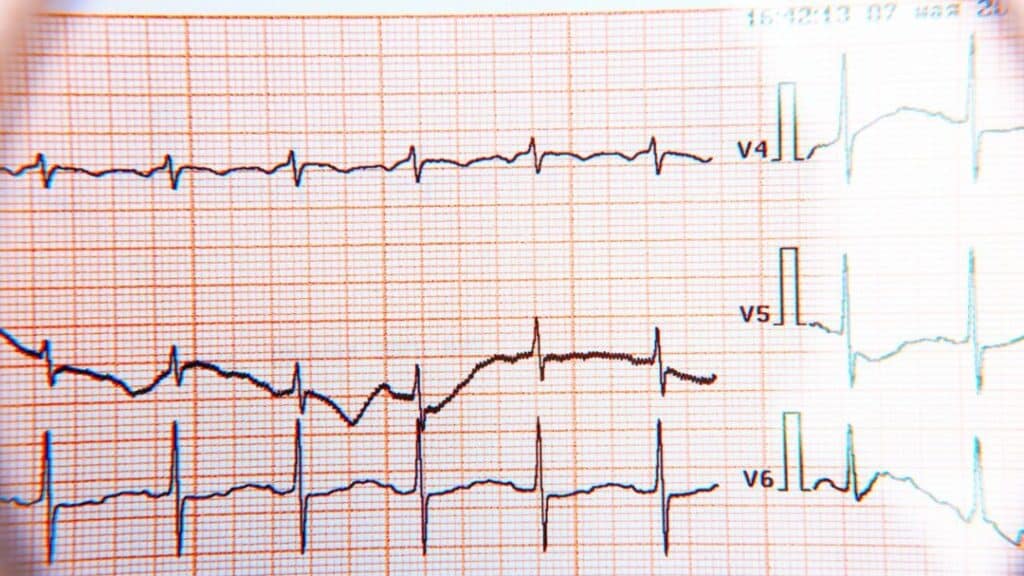 What does or doesn't an electrocardiogram say?