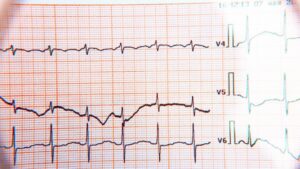 What does or doesn’t an electrocardiogram say?