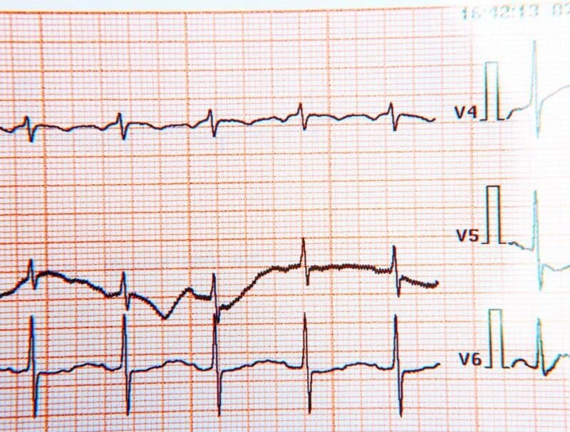 What does or doesn’t an electrocardiogram say?