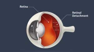 What happens if my retina is detached?