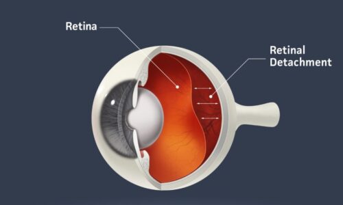 What happens if my retina is detached?