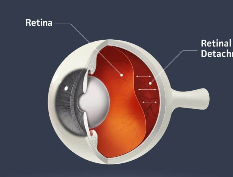 What happens if my retina is detached?