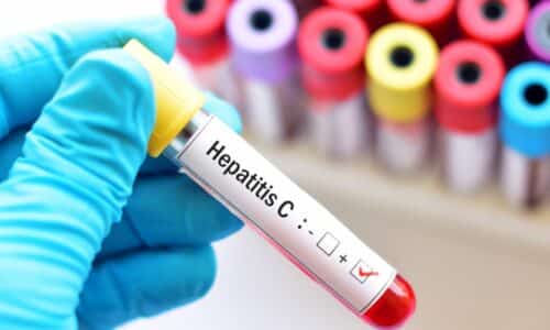 What is Hepatitis C?
