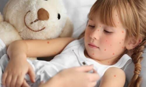Is shingles a recurrent chickn pox?