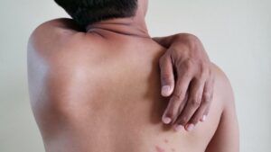 What is shingles?