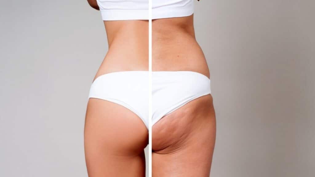 What works and doesn't work on cellulite?