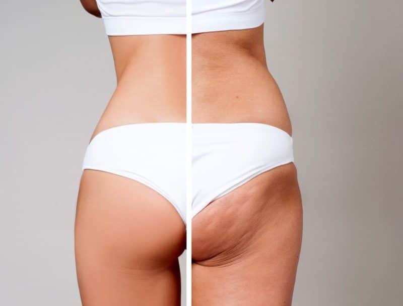 What works and doesn’t work on cellulite?