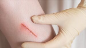 When does a wound need stitches?