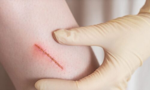 When does a wound need stitches?