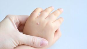 Are there any home remedies for plantar warts?