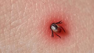 How do I manage a tick bite?