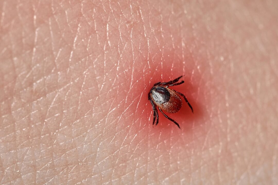 How do I manage a tick bite?