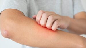 Is itching really a sign of healing?