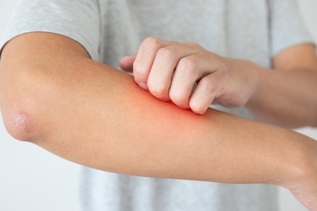 Is itching really a sign of healing?