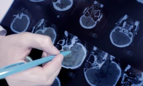 Is there a link between type 2 diabetes and alzheimer’s disease?