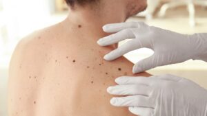 What are the risk factors for melanoma?