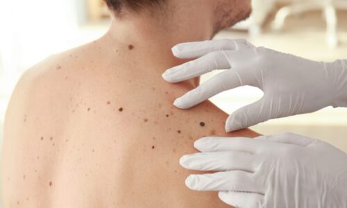 What are the risk factors for melanoma?