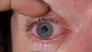 What can I do for a scratched eye?