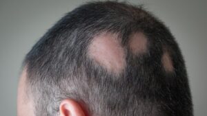 What is Alopecia Areata?