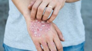 What is Psoriasis?