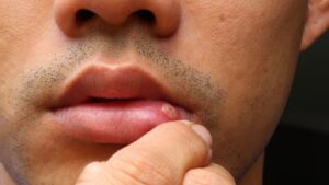 What is a canker sore?