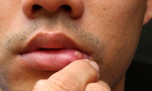What is a canker sore?