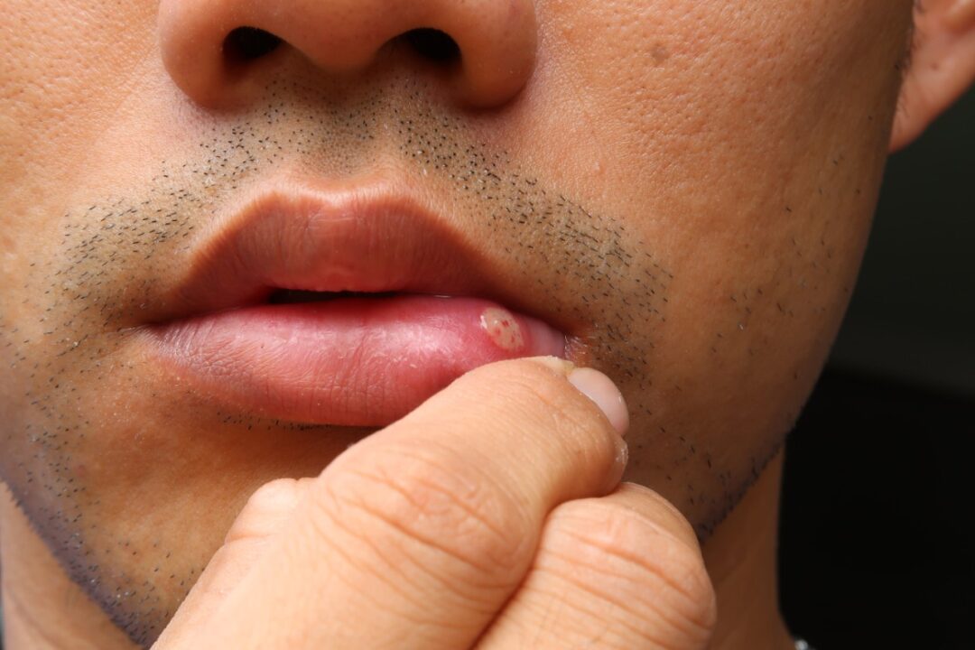 What is a canker sore?