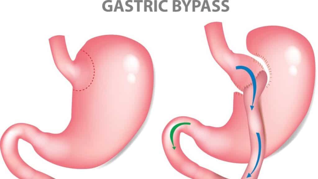 When is Gastric Bypass surgery a good option?