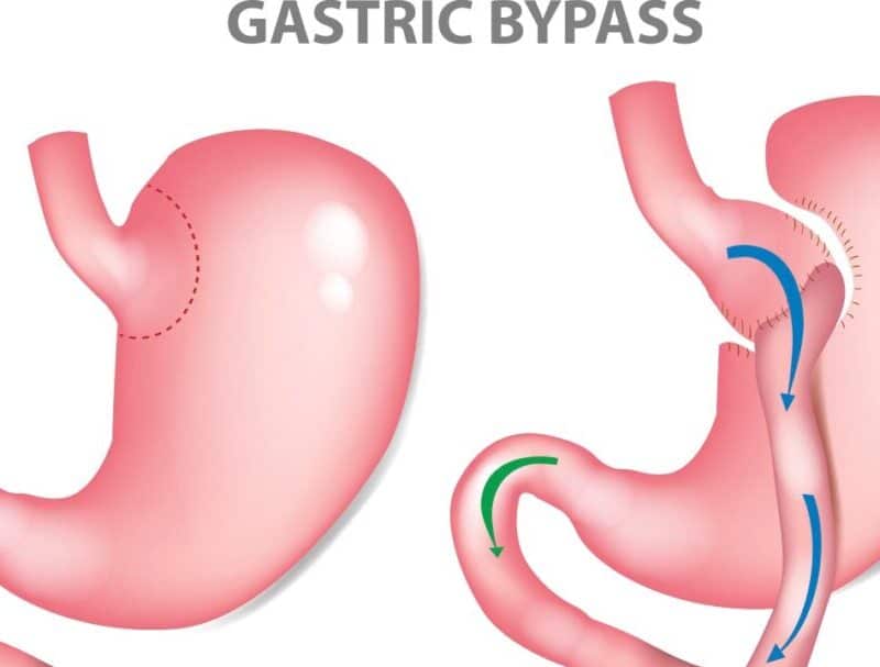 When is Gastric Bypass surgery a good option?