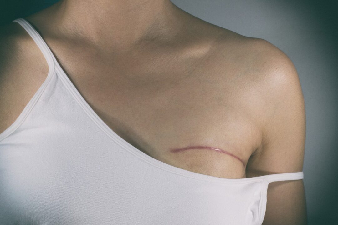 Why do women get a preventive mastectomy?