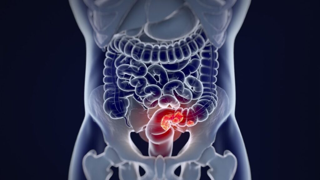 Is Colorectal Cancer screening effective?