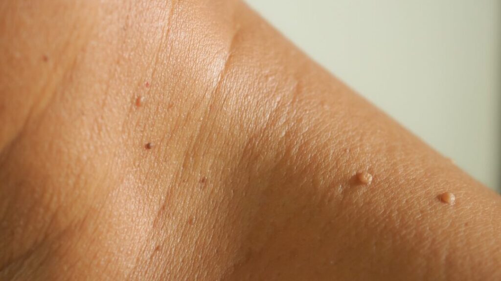 What are Skin Tags?