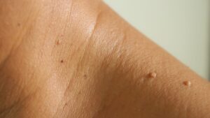 What are Skin Tags?