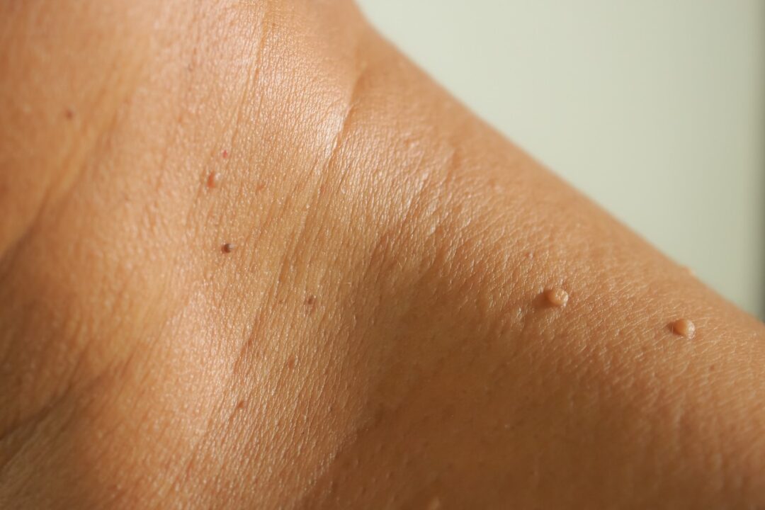 What are Skin Tags?