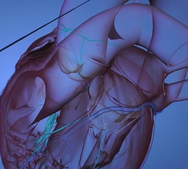 Overview of Fusiform Aneurysm