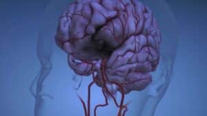 Brain: Ischemic Strokes