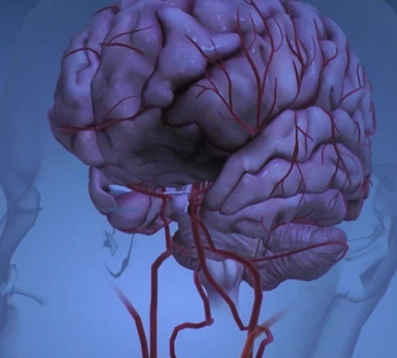 Brain: Ischemic Strokes
