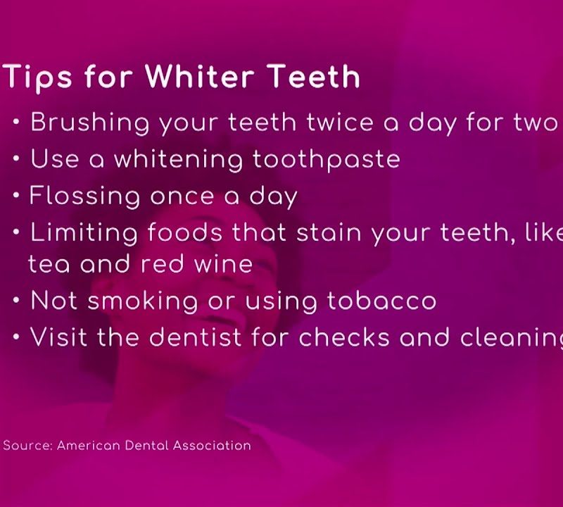 Teeth-Whitening Treatments