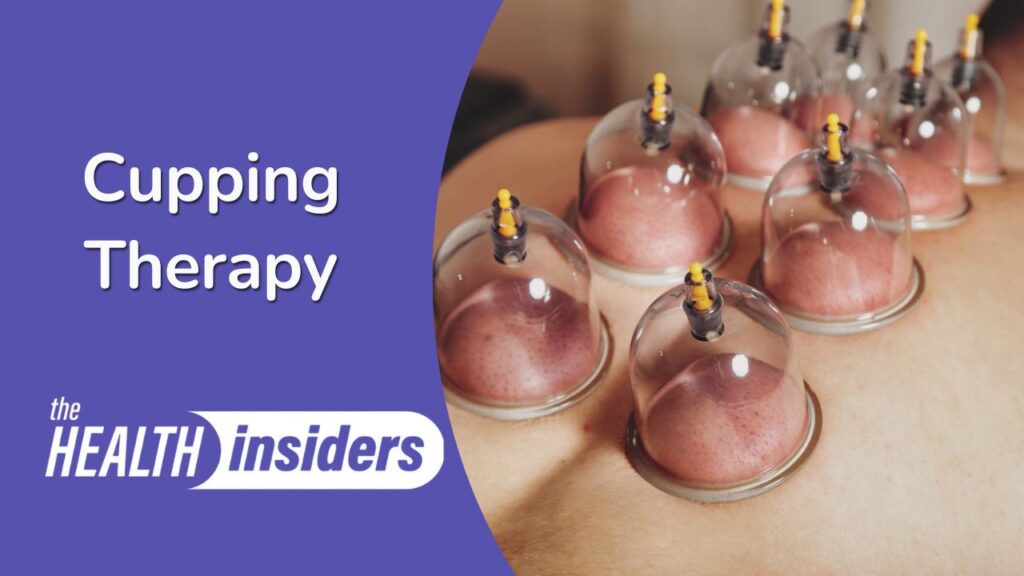 Cupping Therapy