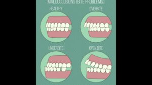 Different Types of Malocclusions